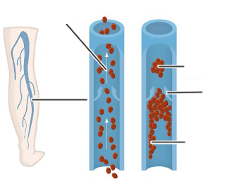 Indicacións para a cirurxía de varices